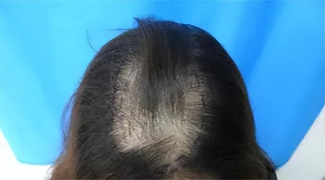 怎么判断自己脱发严重程度（1分钟自测脱发等级）(18)
