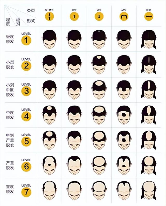 怎么判断自己脱发严重程度（1分钟自测脱发等级）(4)