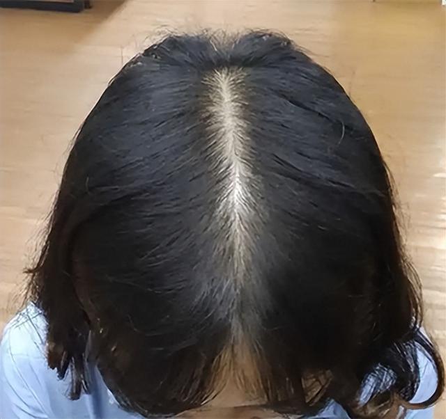 怎么判断自己脱发严重程度（1分钟自测脱发等级）(13)