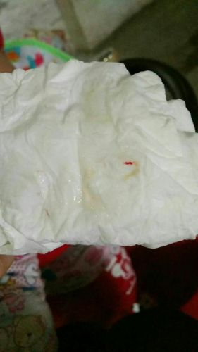 感冒鼻涕带血丝是什么原因？感冒鼻涕带血时要高度警惕-第1张图片-