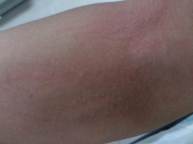 皮肤过敏是什么原因引起(皮肤过敏是什么原因造成的引起的)-第1张图片-