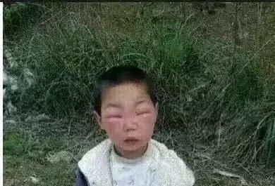 感受下各种被蜜蜂蛰后的样子,大家千万不要招蜂!不然你可能