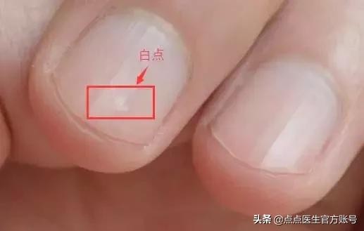 指甲没月牙是身体不健康的表现吗 指甲月牙少就是不健康(2)