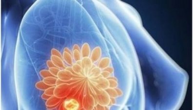 ​乳腺囊肿可以按摩吗 乳腺囊肿按摩会消失吗