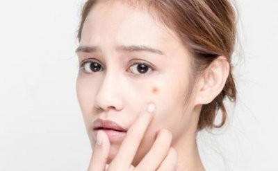 ​长痘痘后要注意什么 长痘痘后怎么办