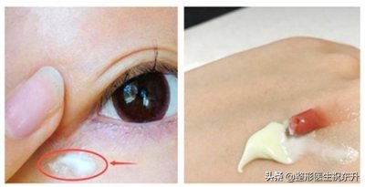 ​做完外切祛眼袋手术，我后悔了：后悔没早做