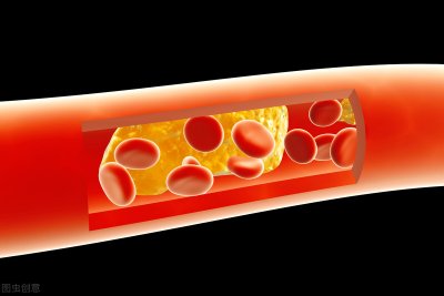 ​血管硬化怎么办快速恢复（诊断为动脉硬化如何是好？在生活上做到这6点，可缓