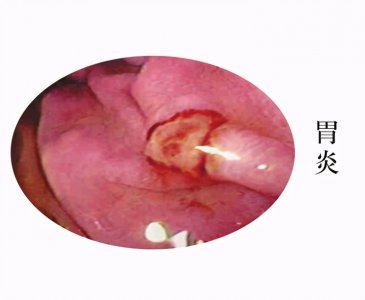 ​胃炎的症状有哪些表现（对照胃炎的4种常见症状表现，该怎么预防？）