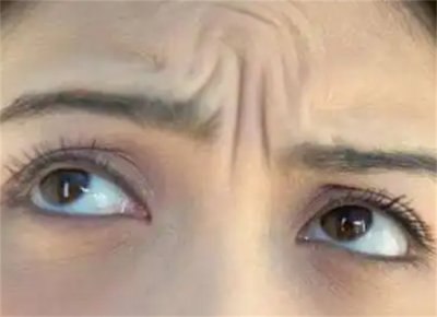 ​从小就有抬头纹怎么办