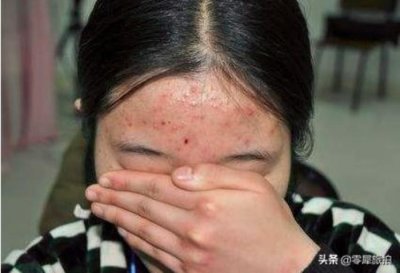 ​女生青春痘治疗方法，女生脸上长痘痘怎么办