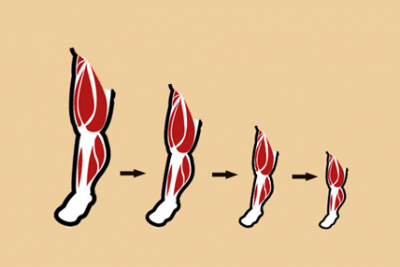 ​肌肉萎缩症 为什么久不运动，肌肉会萎缩？