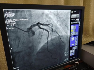 ​心脏造影检查是什么