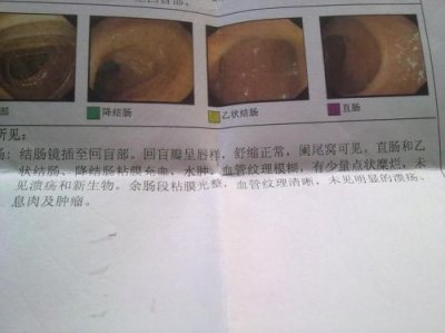 ​结肠炎的早期症状表现(肠息肉结肠炎的早期症状)