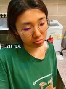 ​女子减肥吃胡萝卜变“小橘人” 医生揭秘原因并提出警示