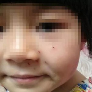 ​女童被老师扎6个洞 脸上清晰可见六个血窟窿